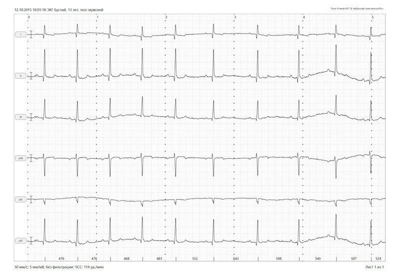 ekg Электрокардиография (ЭКГ)