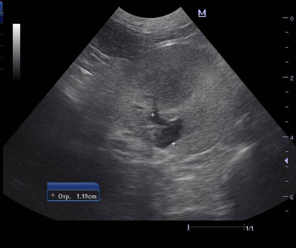 image013 УЗ-исследование почек