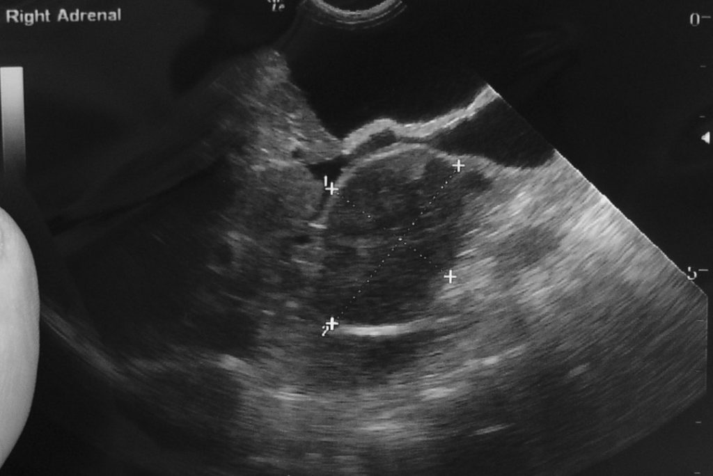 right-adrenal-U-S-1024x684 УЗ-исследование надпочечников