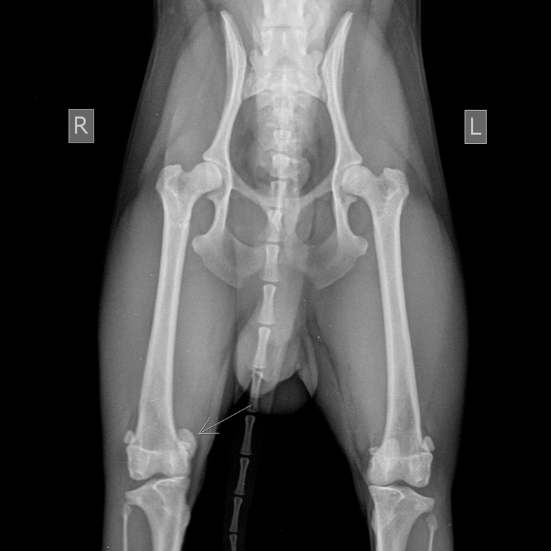 medialnyy-vyvih-pravoy-kolennoy-chashechki Диагностика и лечение вывиха коленной чашечки (Patella luxation)
